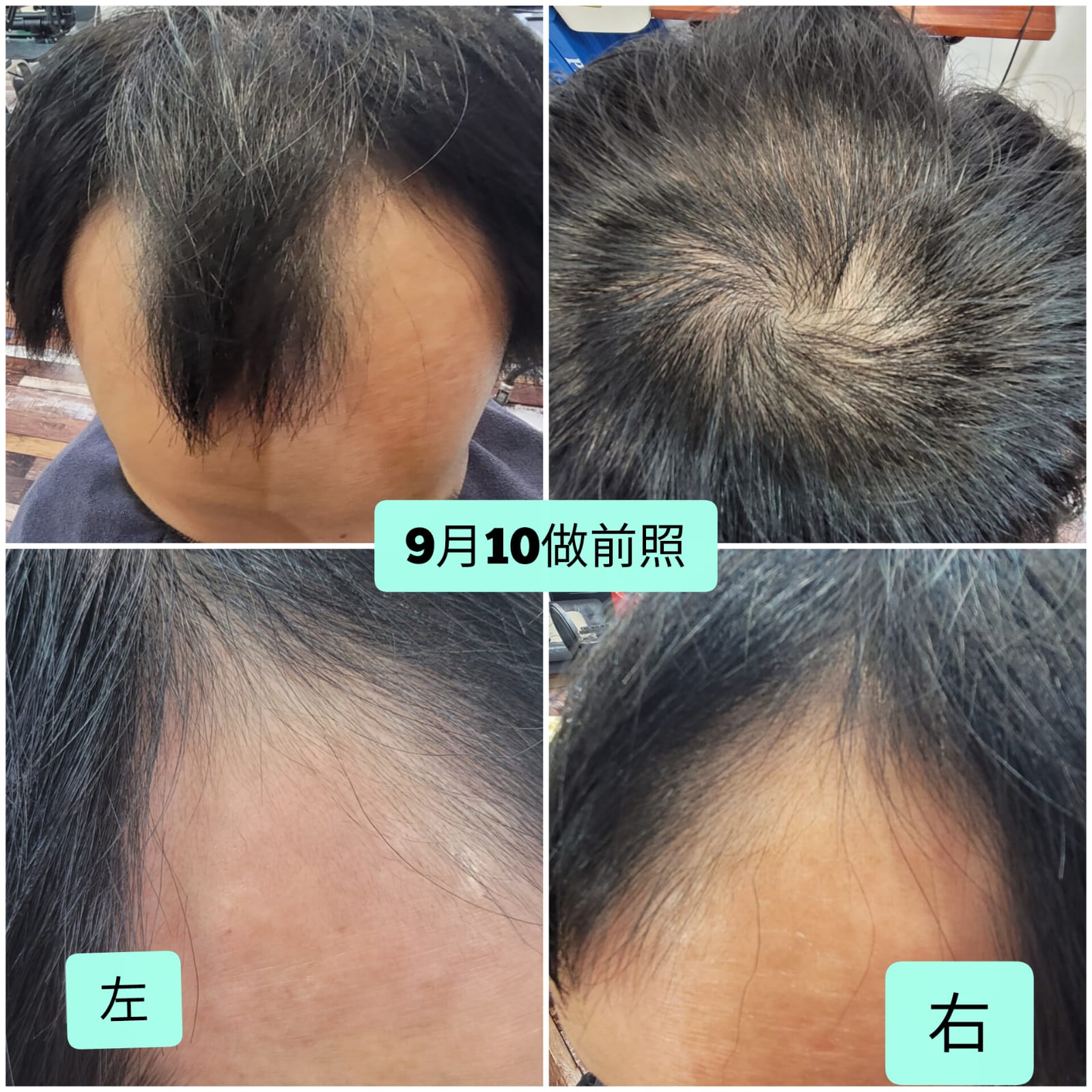 治療前:嚴重M字額