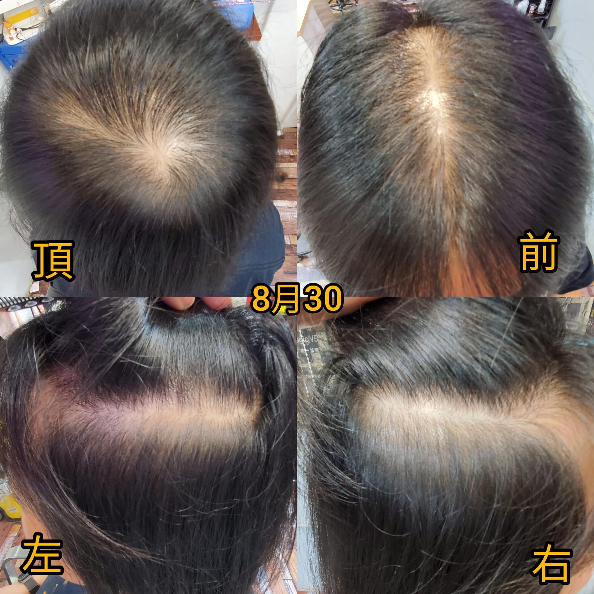 治療前:稀疏脆弱